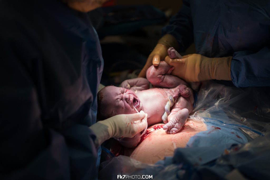 Photos de naissance par césarienne d'un bébé à l'hôpital.